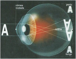 Astigmatismo