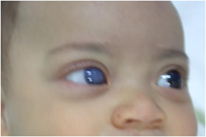 Glaucoma Congênito