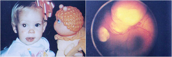 Retinoblastoma